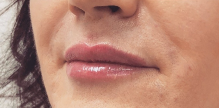 Preenchimento labial 2 Depois
